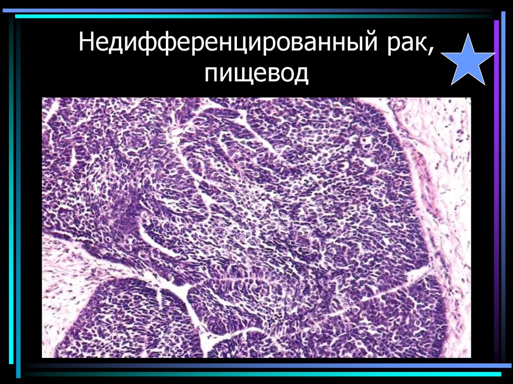 Недифференцированный рак, пищевод