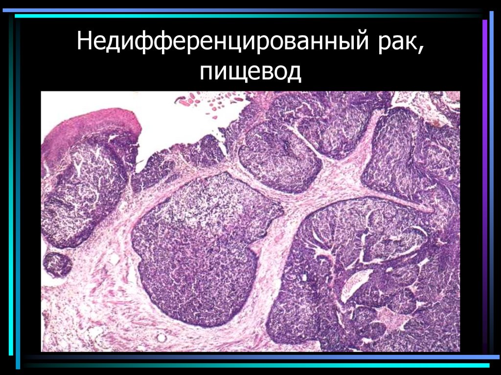 Недифференцированный рак, пищевод