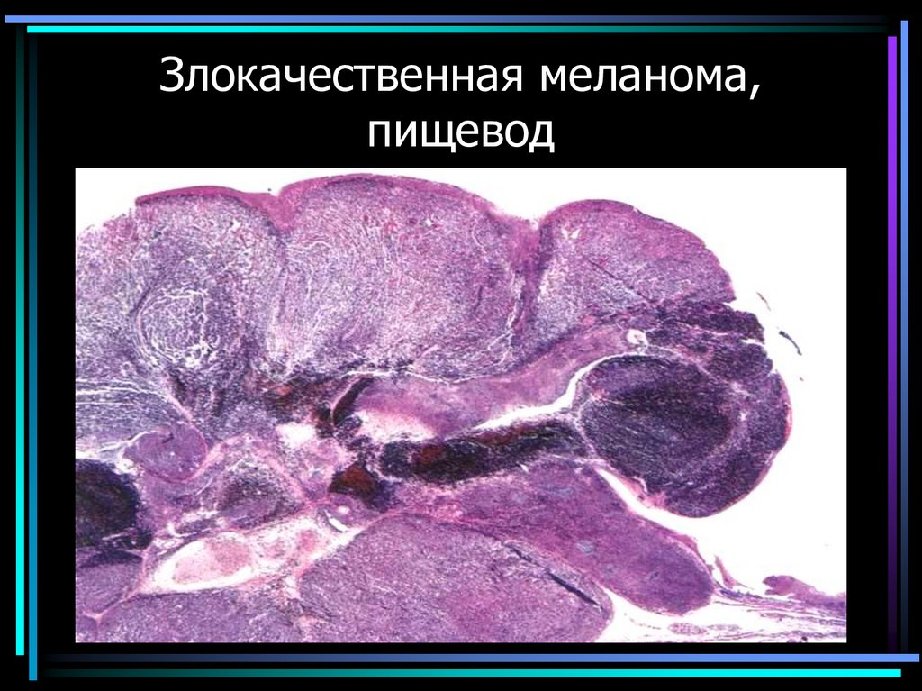 Злокачественная меланома, пищевод