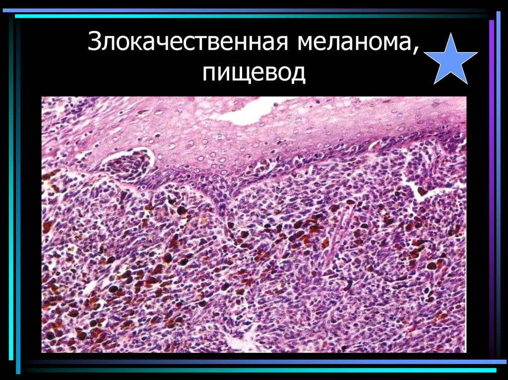 Злокачественная меланома, пищевод