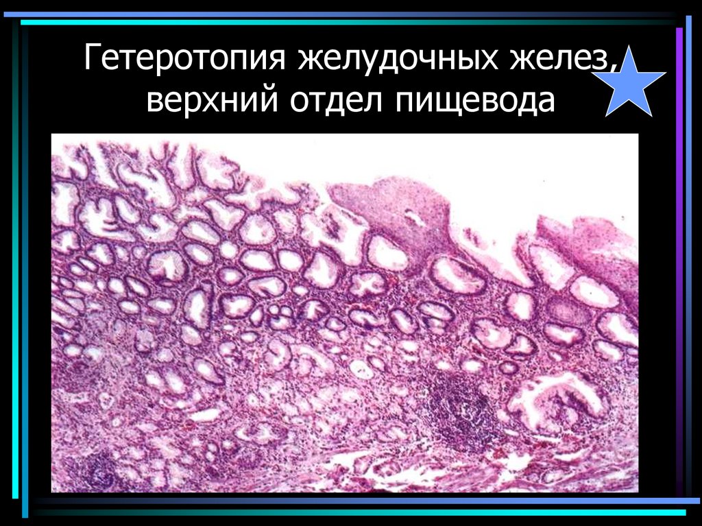 Гетеротопия желудочных желез, верхний отдел пищевода