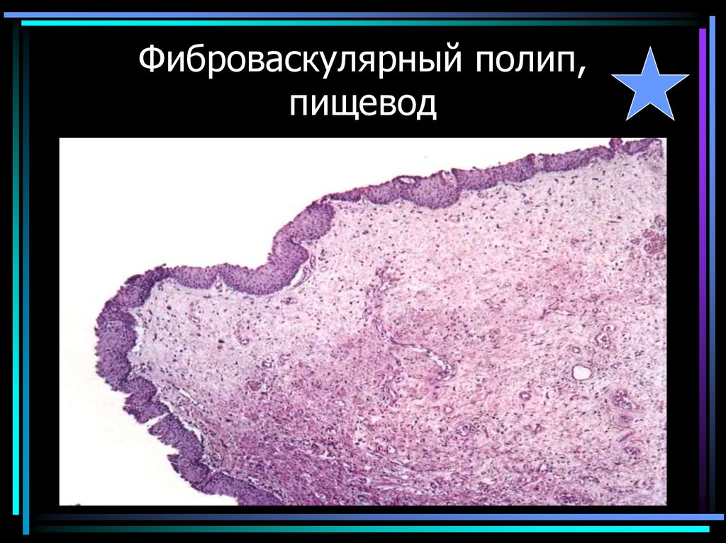 Фиброваскулярный полип, пищевод