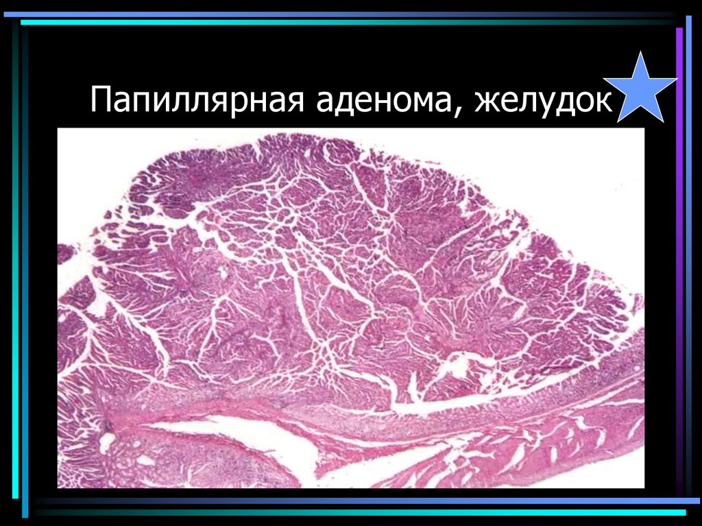 Папиллярная аденома, желудок