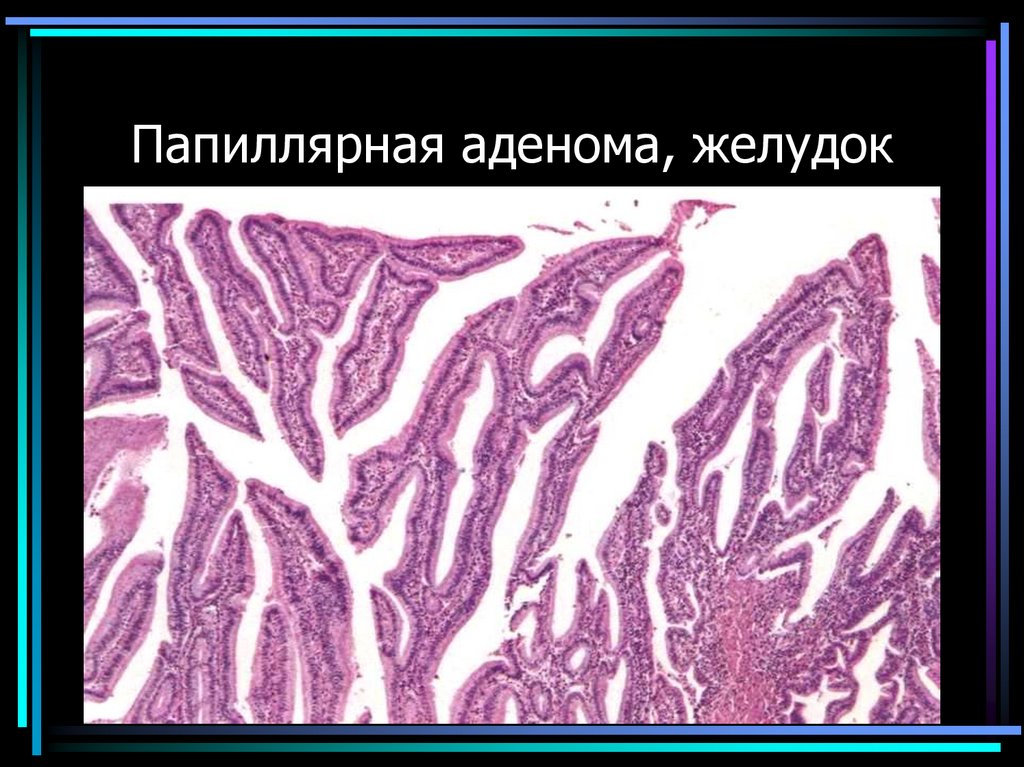 Папиллярная аденома, желудок