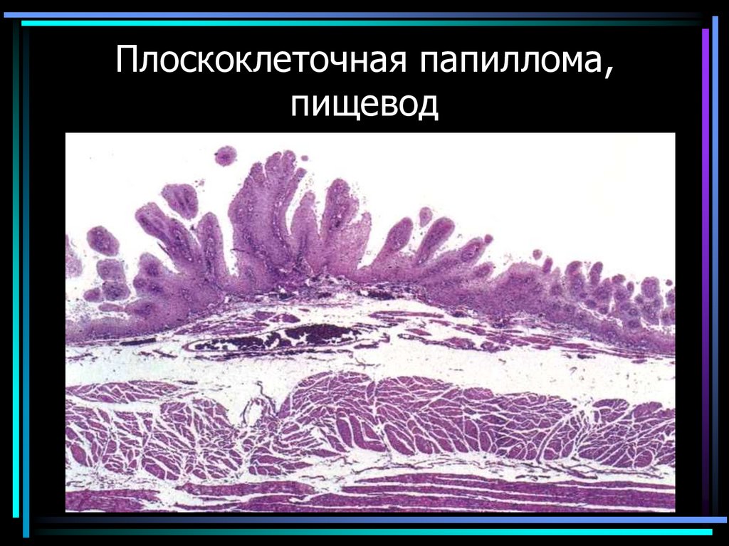 Плоскоклеточная папиллома, пищевод