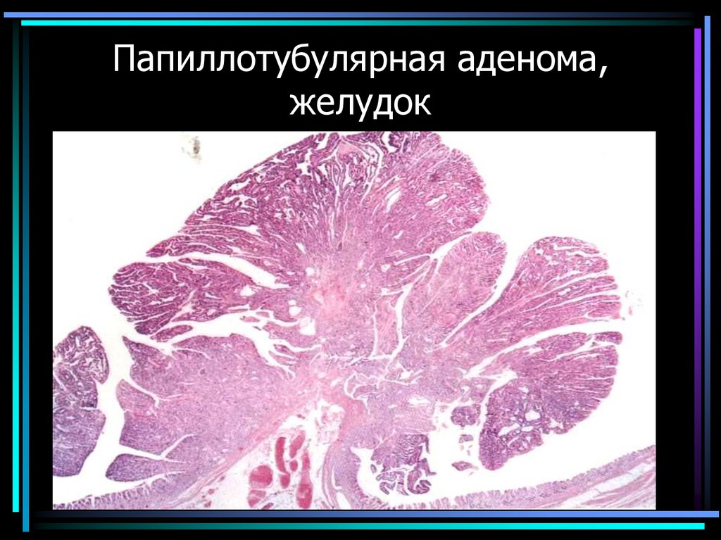 Папиллотубулярная аденома, желудок