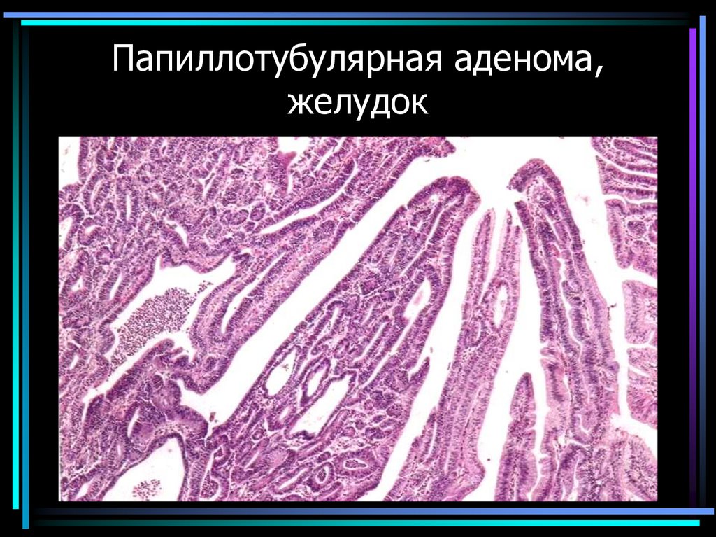 Папиллотубулярная аденома, желудок