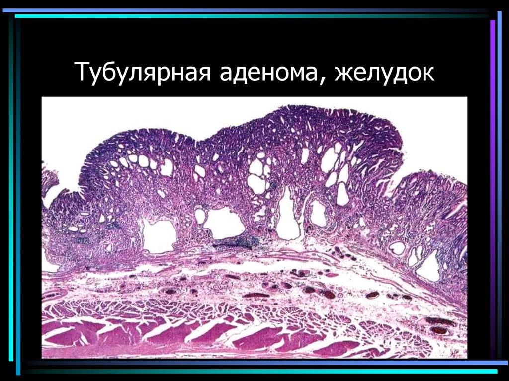 Тубулярная аденома, желудок