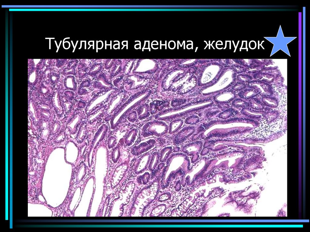 Тубулярная аденома, желудок