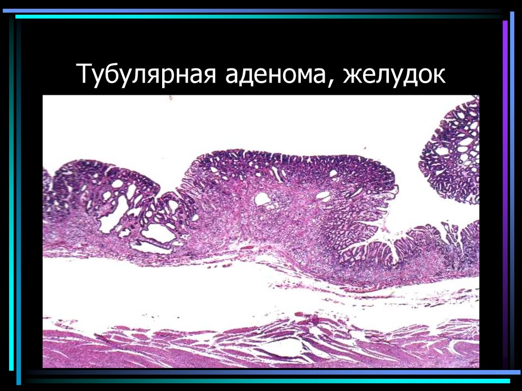 Тубулярная аденома, желудок