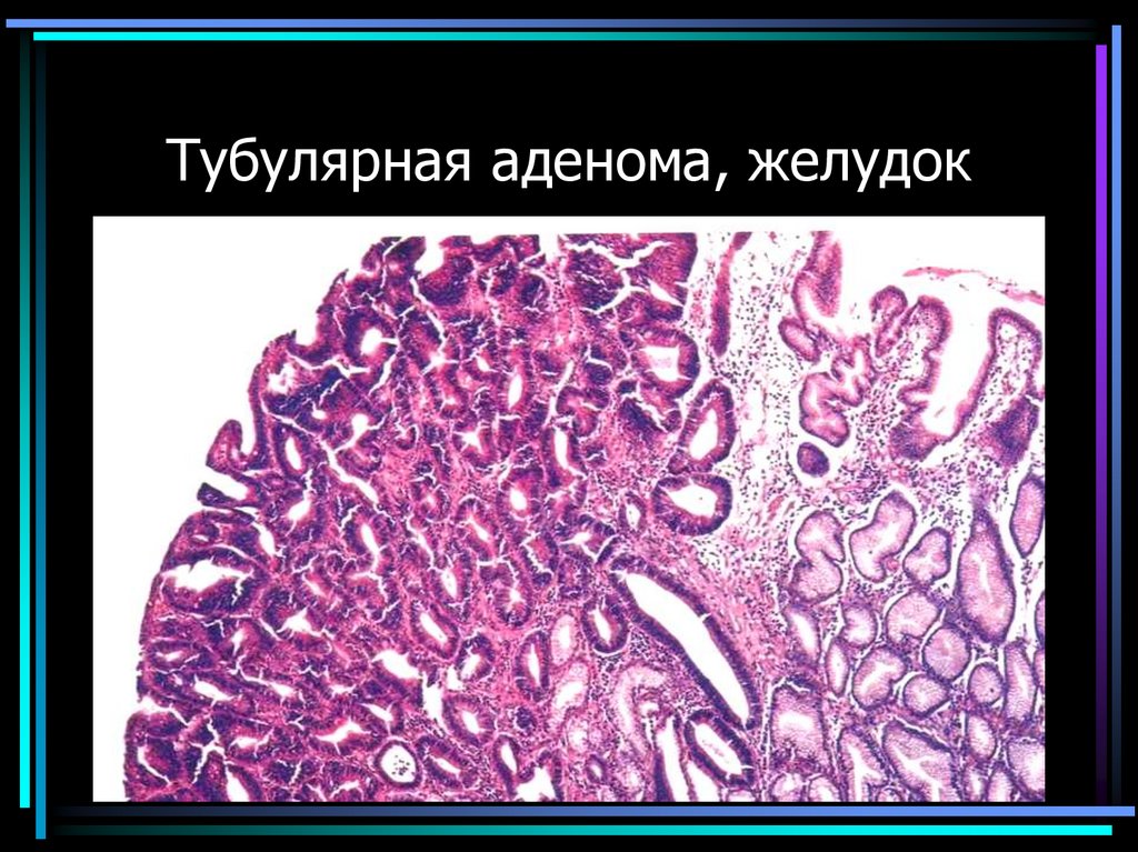 Тубулярная аденома, желудок