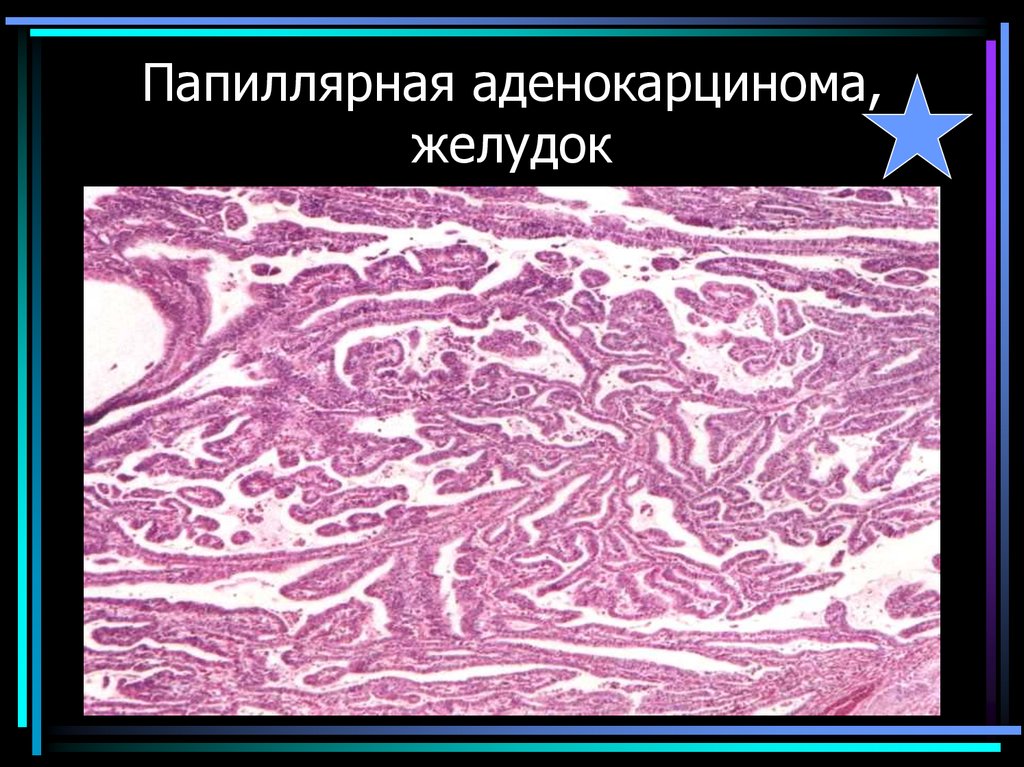 Папиллярная аденокарцинома, желудок