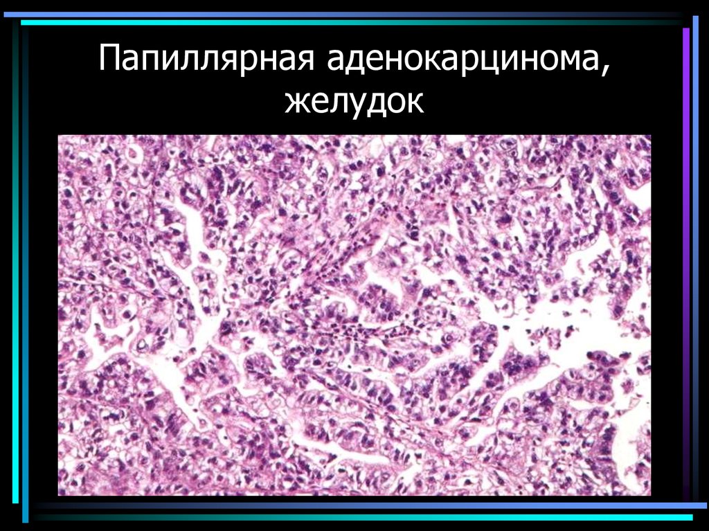 Папиллярная аденокарцинома, желудок