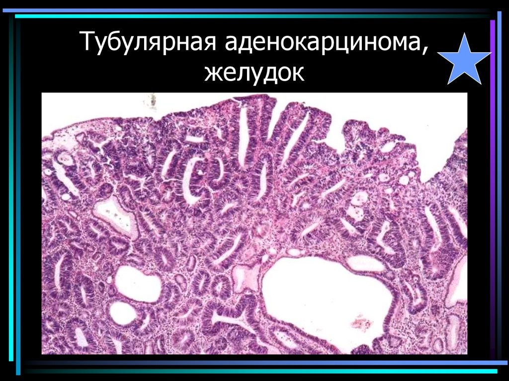 Тубулярная аденокарцинома, желудок