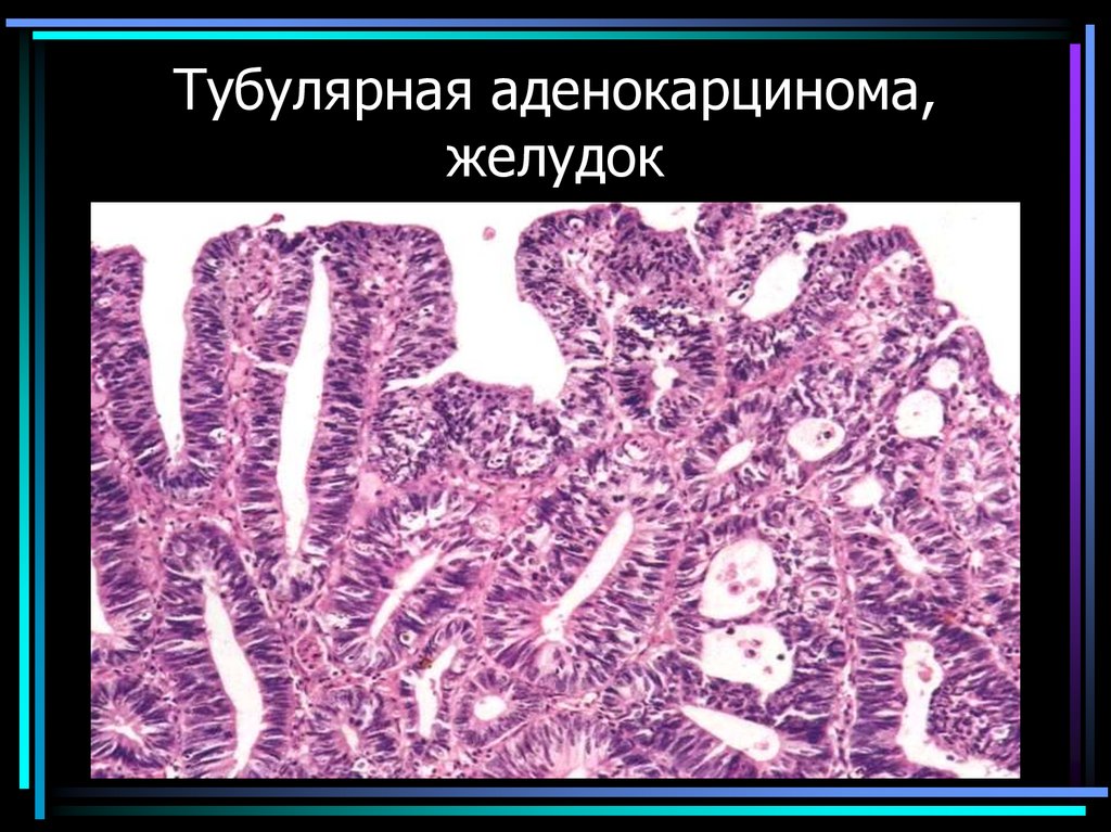 Тубулярная аденокарцинома, желудок