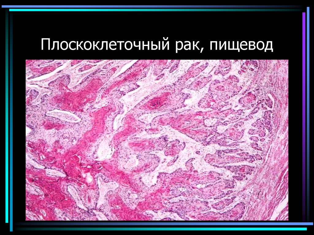 Плоскоклеточный рак, пищевод