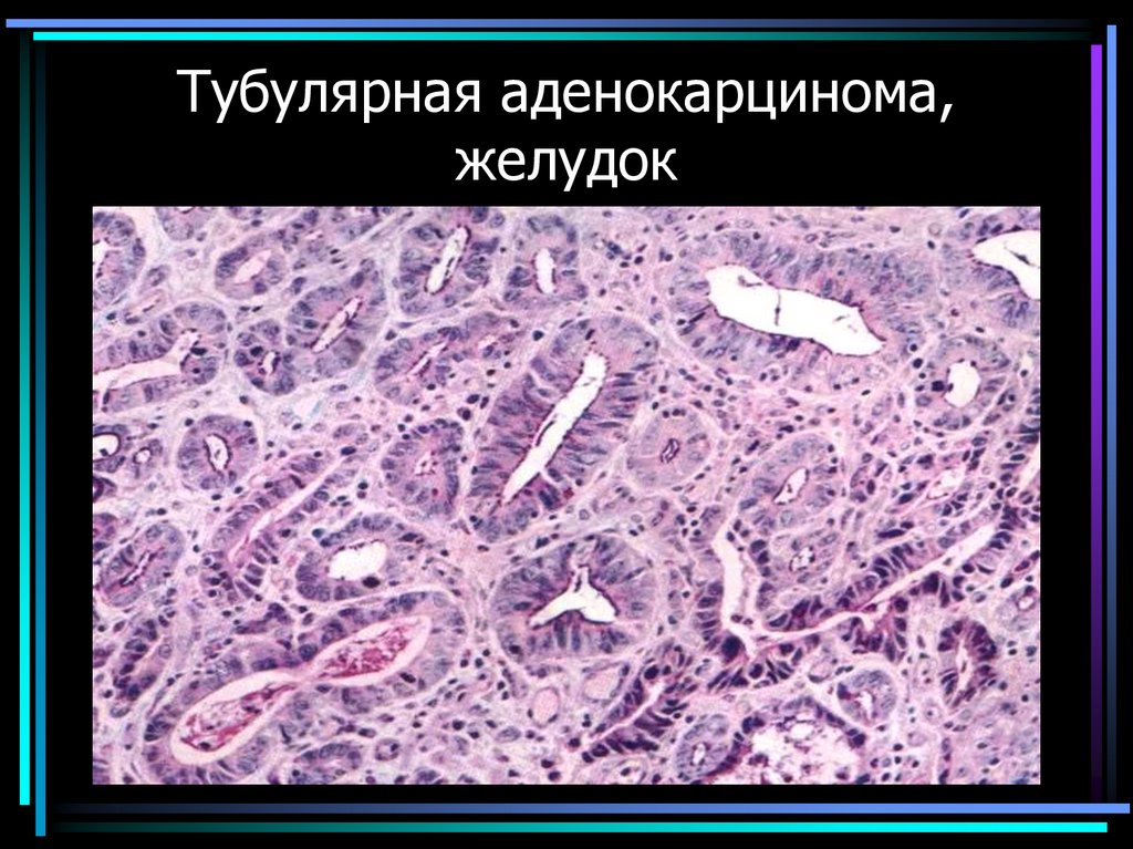 Тубулярная аденокарцинома, желудок