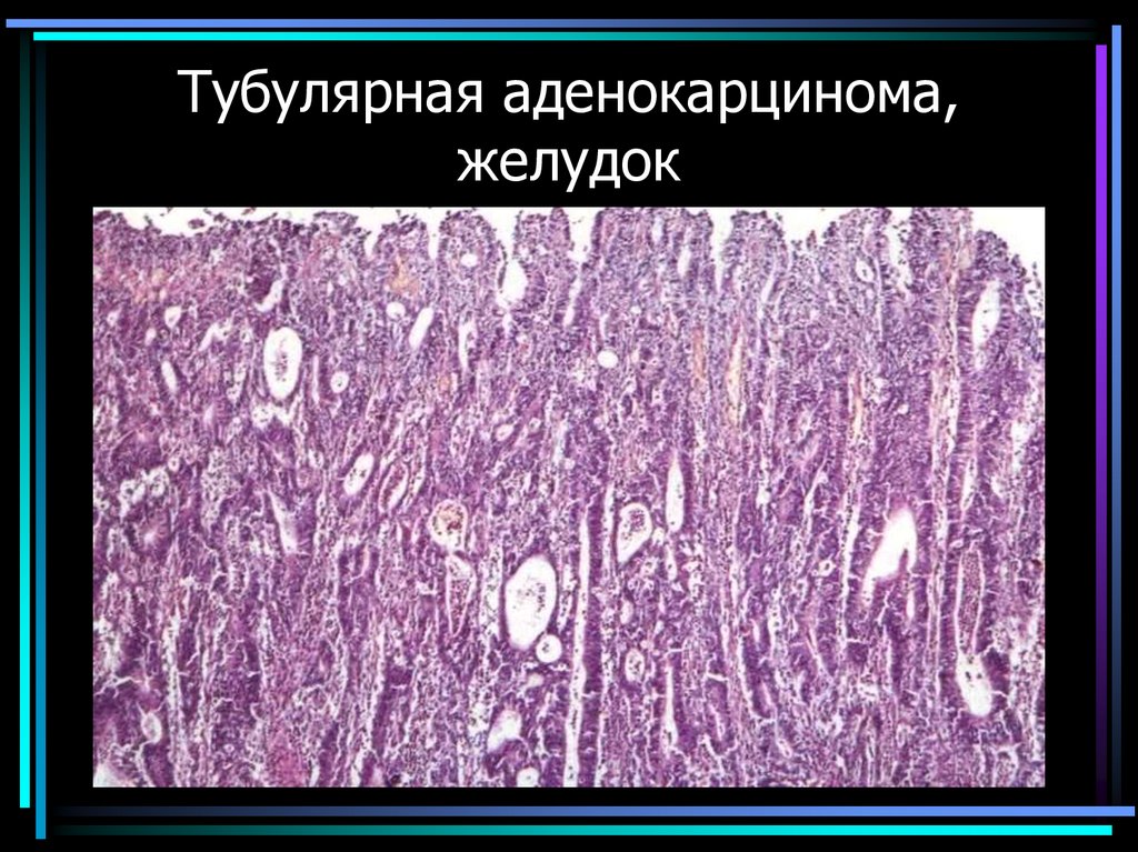 Тубулярная аденокарцинома, желудок