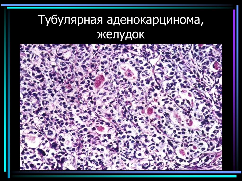 Тубулярная аденокарцинома, желудок