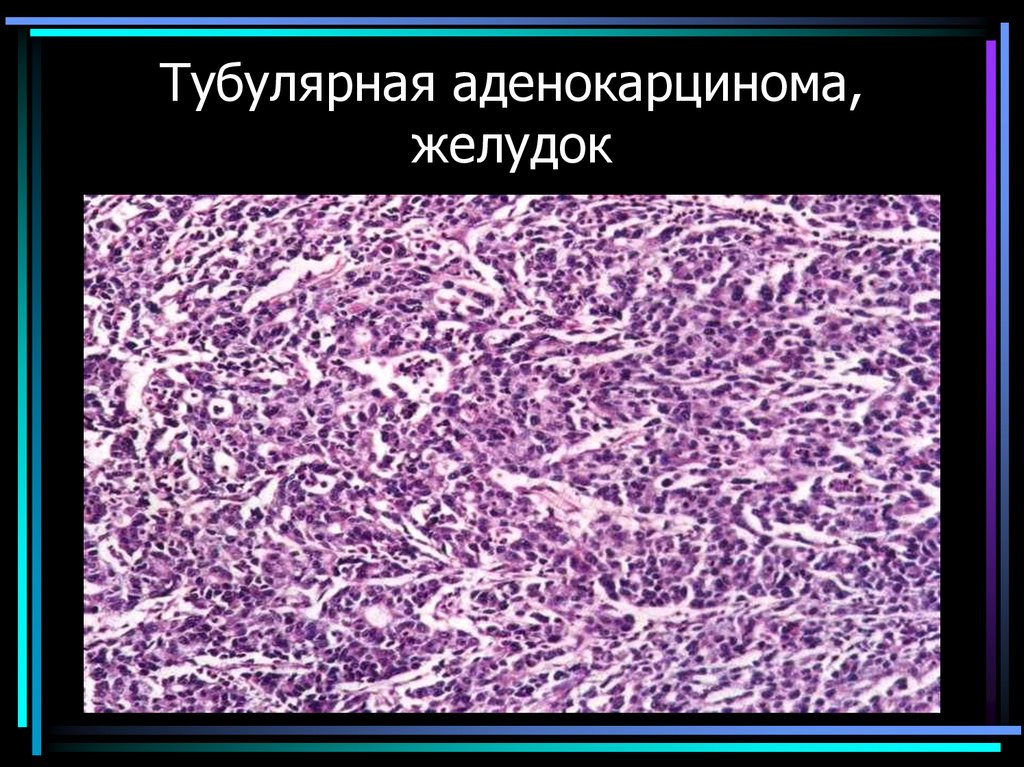 Тубулярная аденокарцинома, желудок