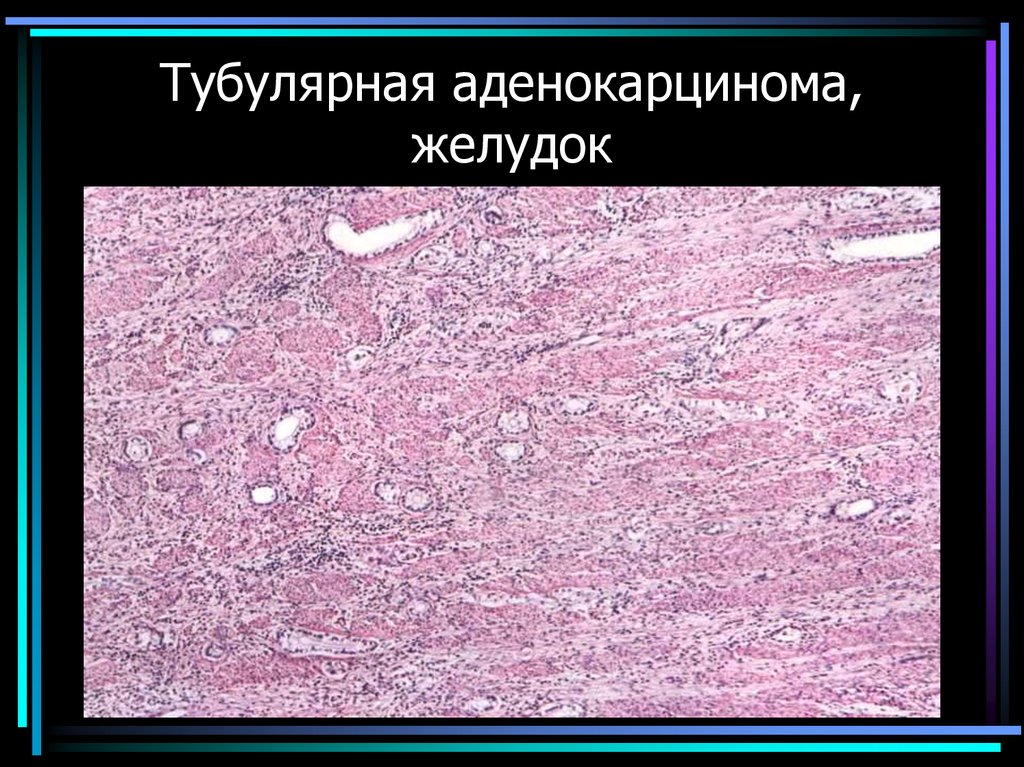 Тубулярная аденокарцинома, желудок