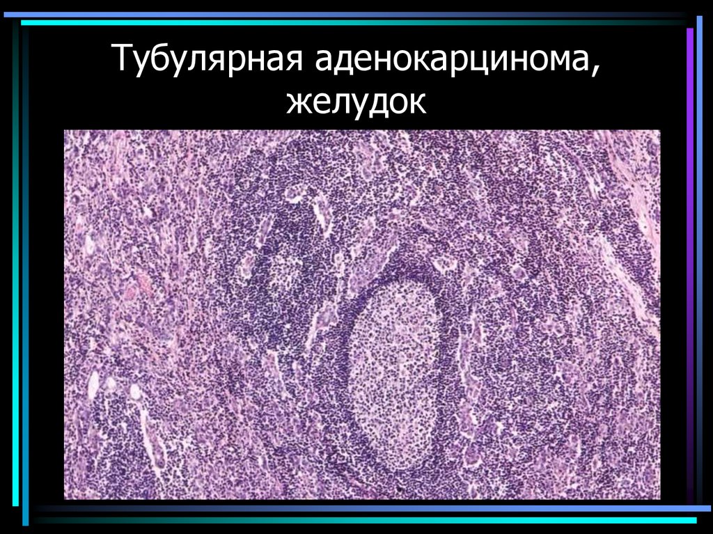 Тубулярная аденокарцинома, желудок