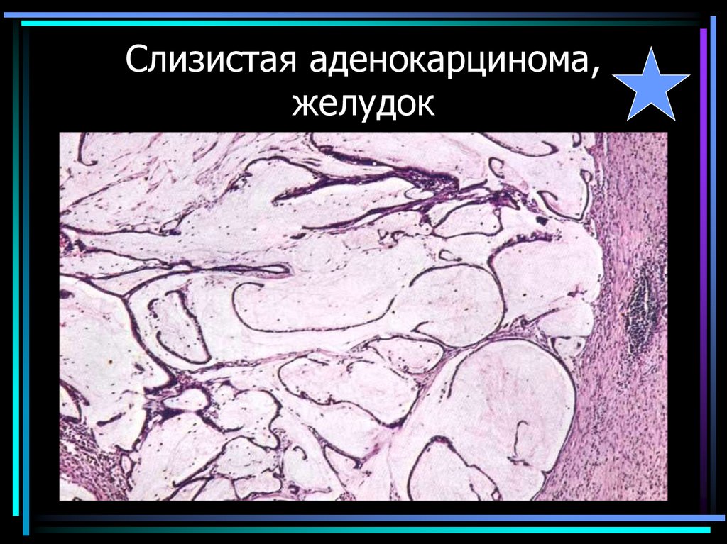 Слизистая аденокарцинома, желудок