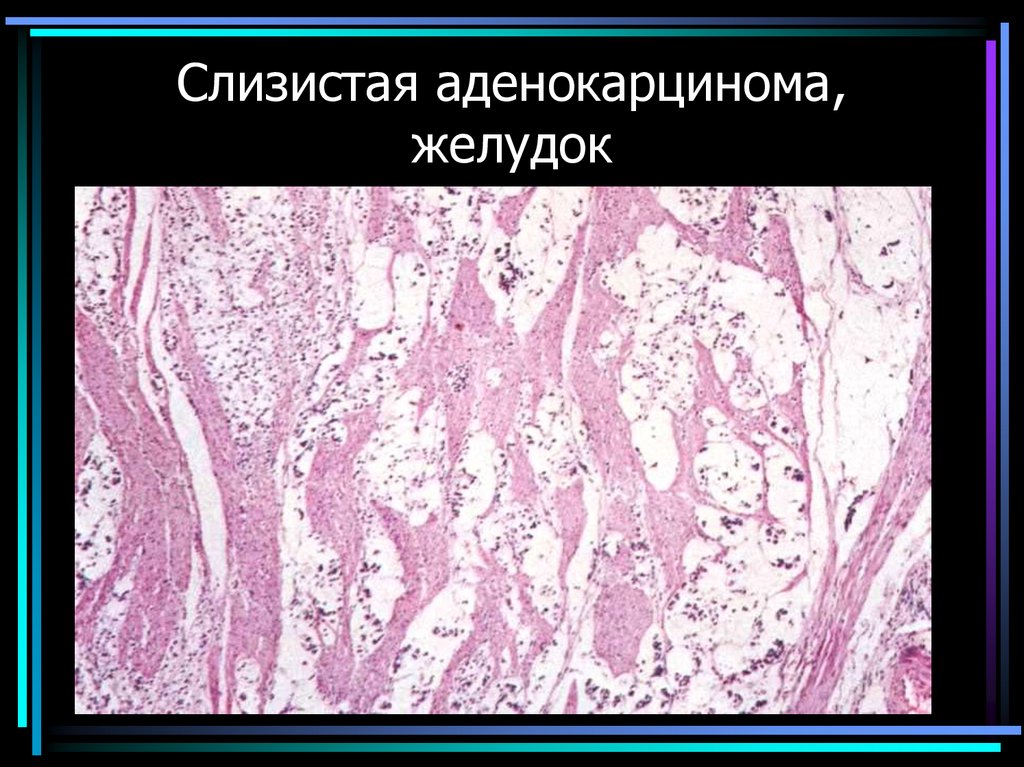 Слизистая аденокарцинома, желудок