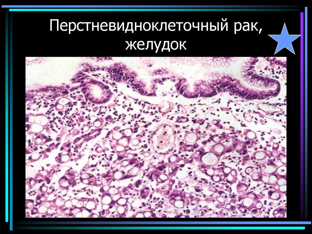 Перстневидноклеточный рак, желудок