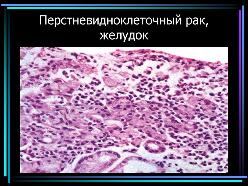 Перстневидноклеточный рак, желудок