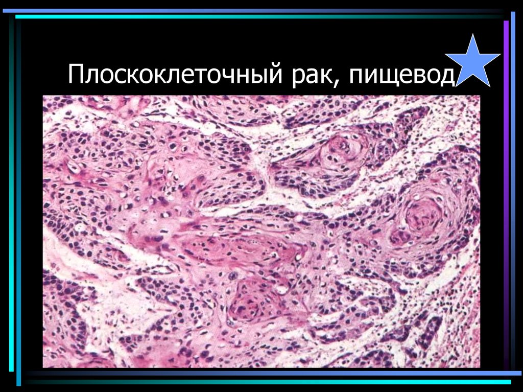 Плоскоклеточный рак, пищевод