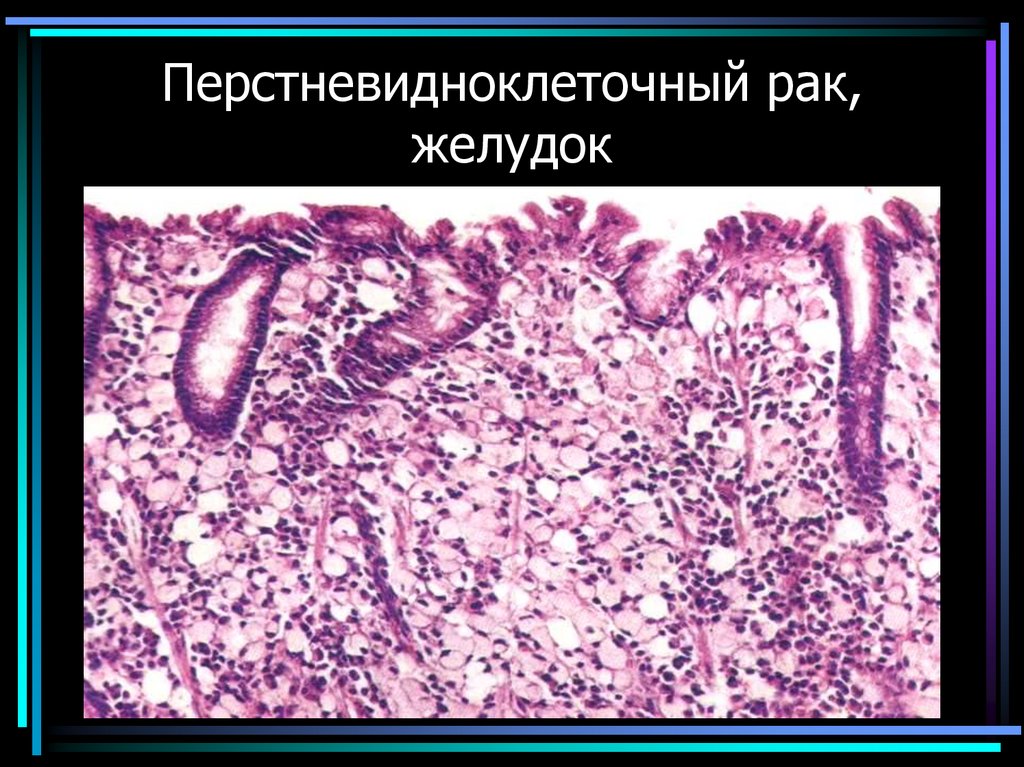 Перстневидноклеточный рак, желудок