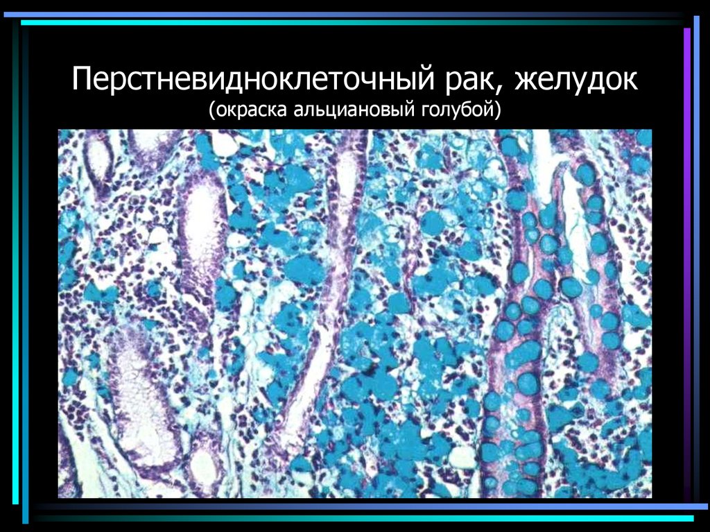 Перстневидноклеточный рак, желудок (окраска альциановый голубой)