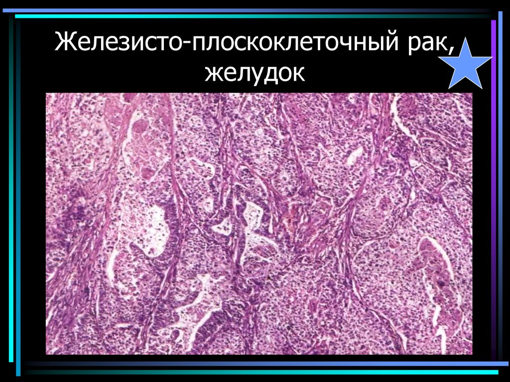 Железисто-плоскоклеточный рак, желудок