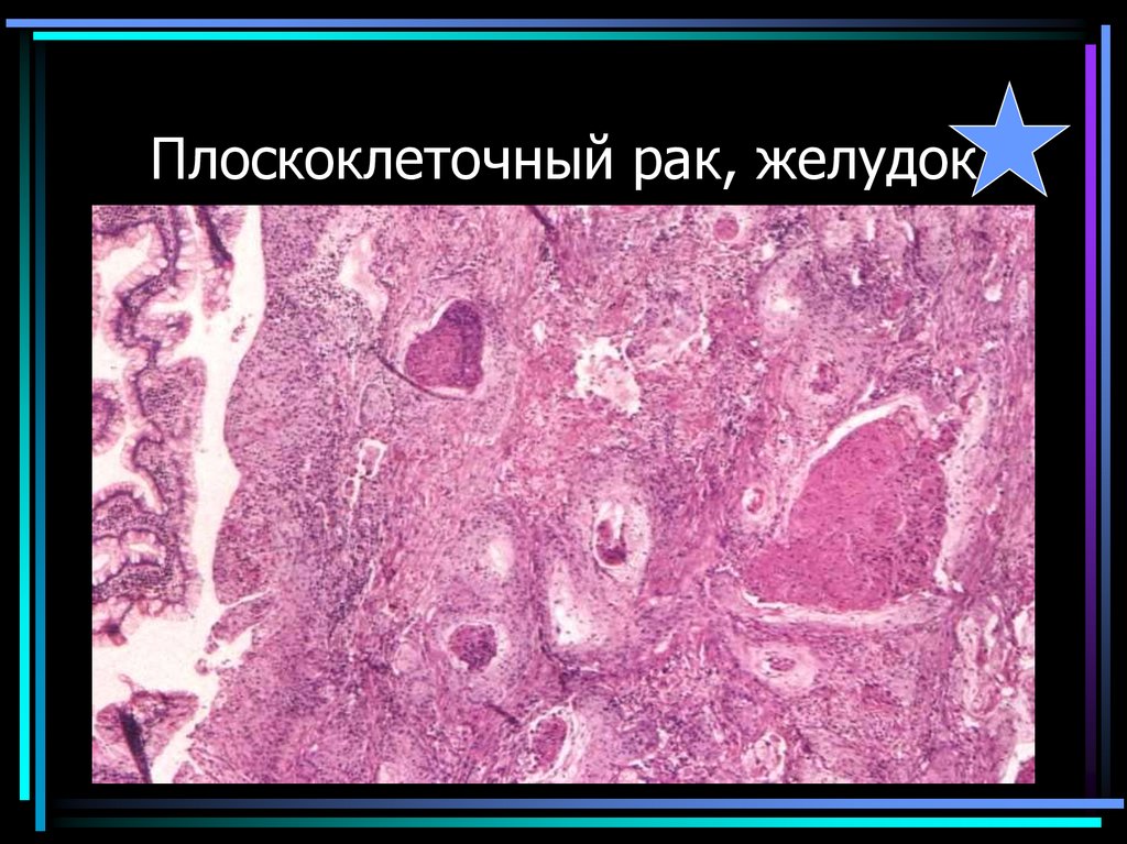 Плоскоклеточный рак, желудок