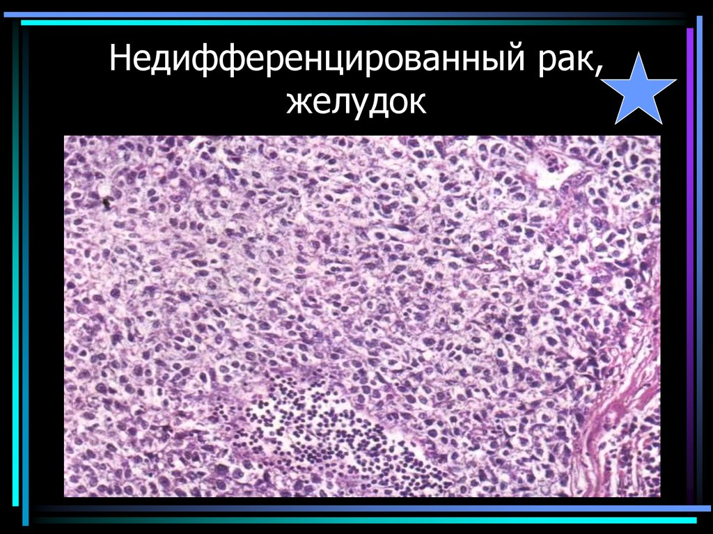 Недифференцированный рак, желудок