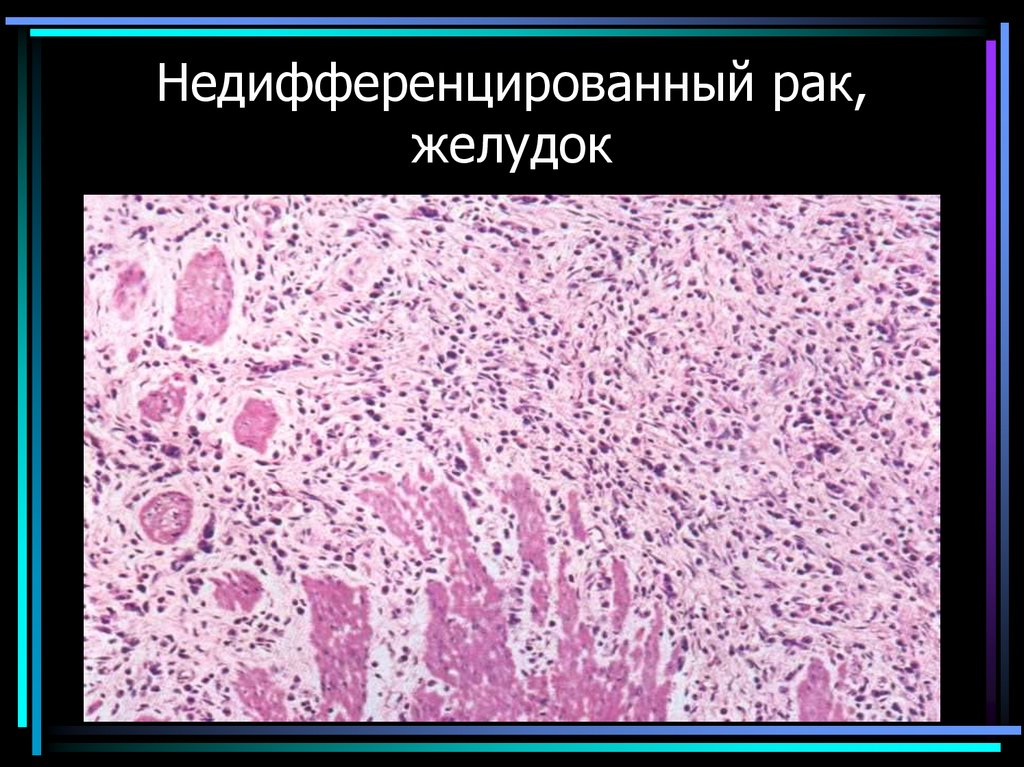 Недифференцированный рак, желудок