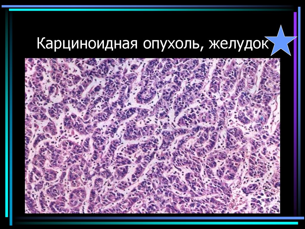 Карциноидная опухоль, желудок