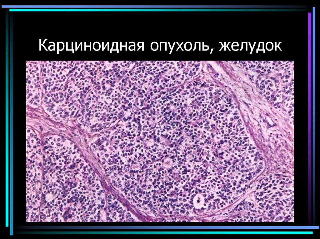 Карциноидная опухоль, желудок