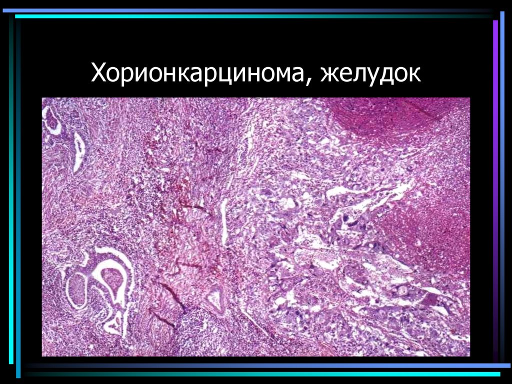 Хорионкарцинома, желудок