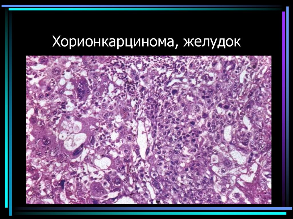 Хорионкарцинома, желудок