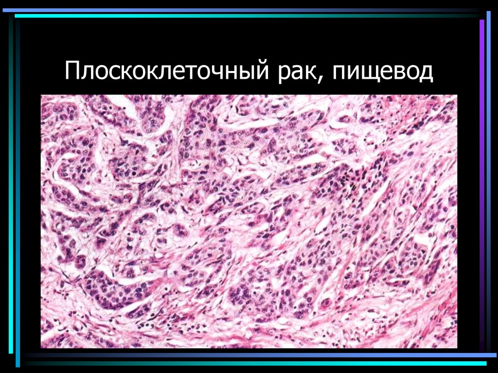 Плоскоклеточный рак, пищевод