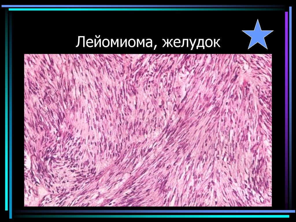 Лейомиома, желудок