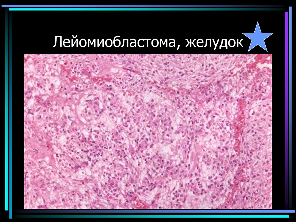 Лейомиобластома, желудок