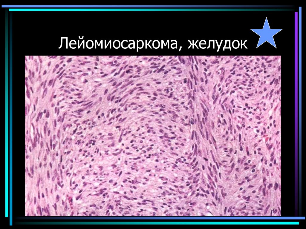 Лейомиосаркома, желудок