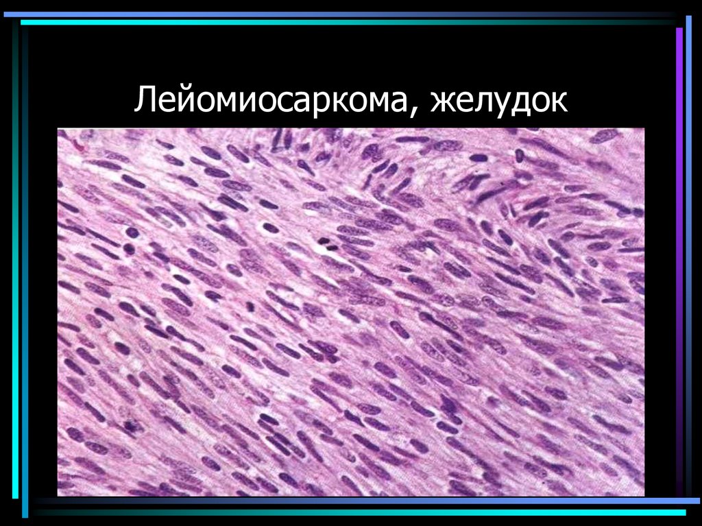 Лейомиосаркома, желудок