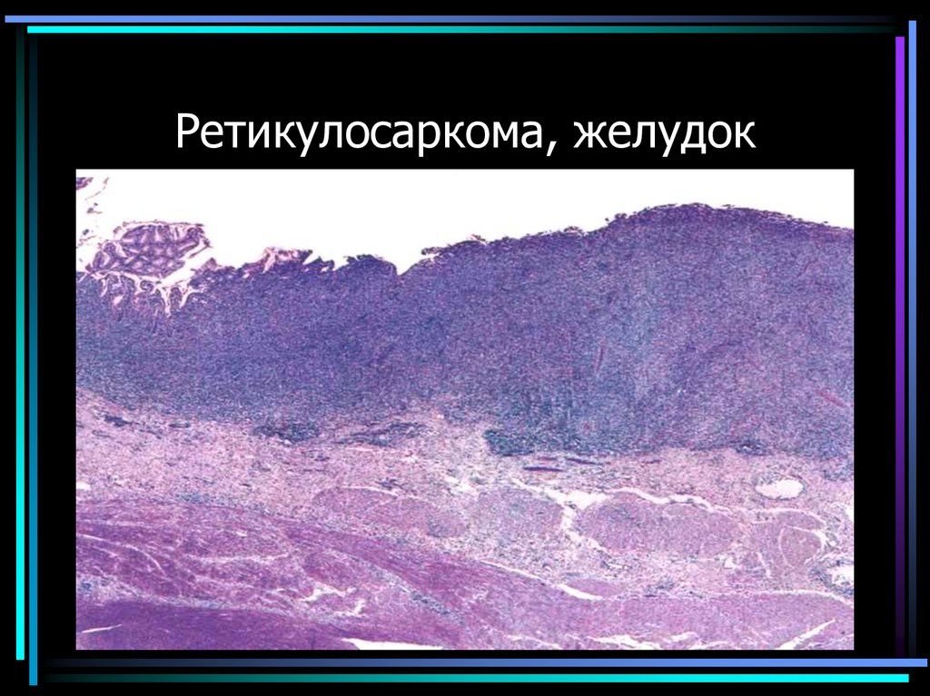 Ретикулосаркома, желудок