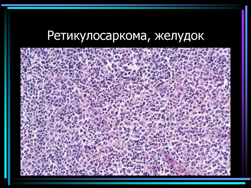 Ретикулосаркома, желудок