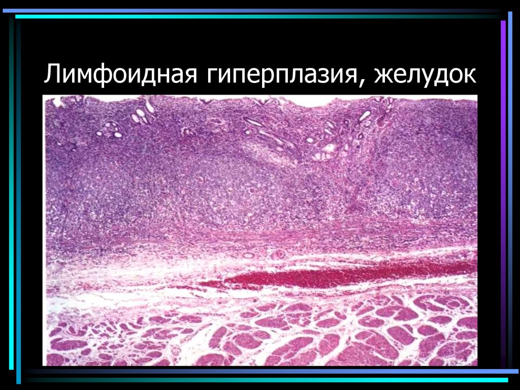 Лимфоидная гиперплазия, желудок