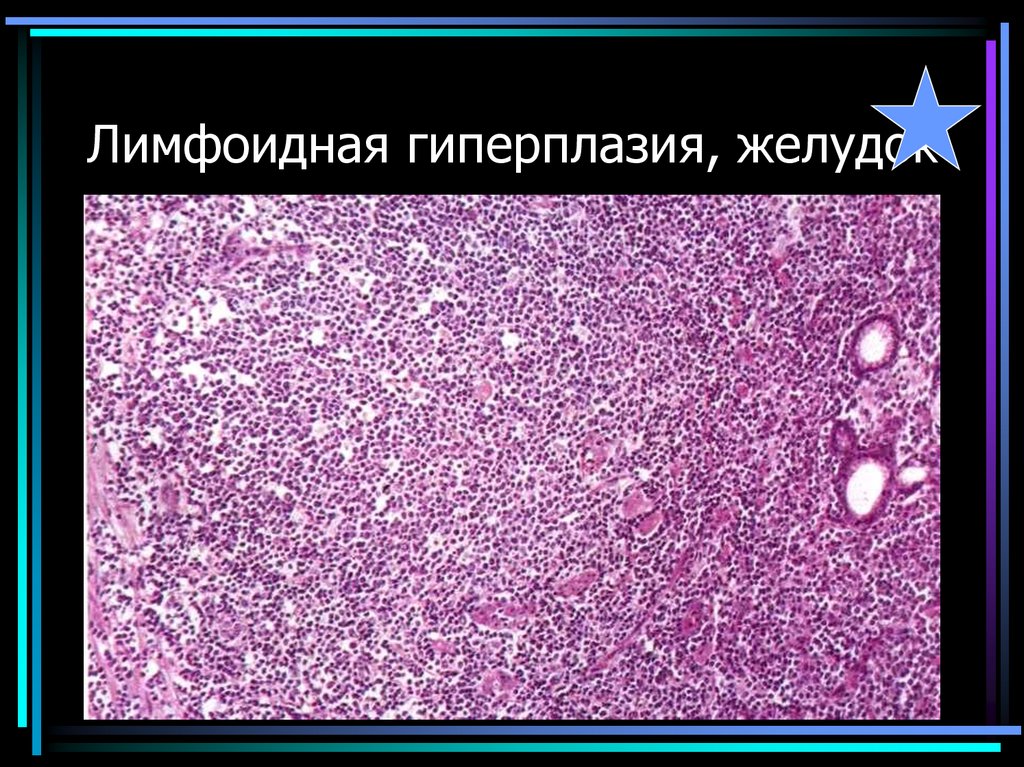 Лимфоидная гиперплазия, желудок